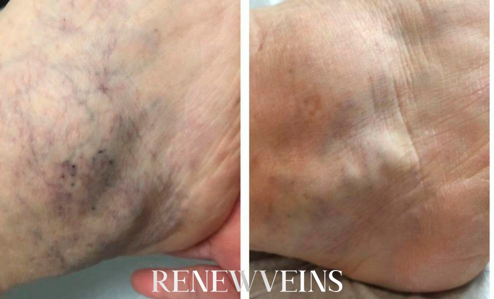 dep3_edit_renewveins.jpg?v=1792004803