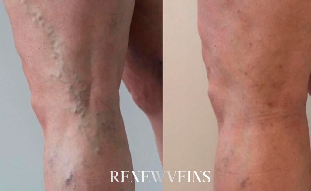 dep4_edit_renewveins-1024x628-1.jpg?v=1792004803