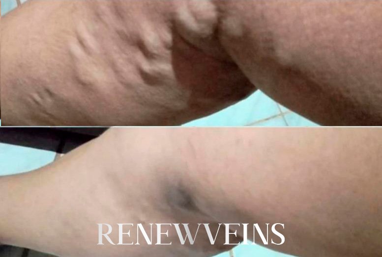 dep5_edit_renewveins2.jpg?v=1792004803
