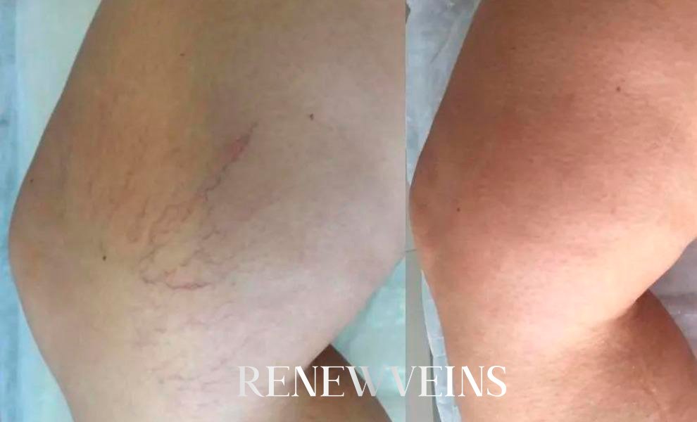 dep6_edit_renewveins.jpg?v=1792004803